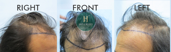 Hairline Designing 2800